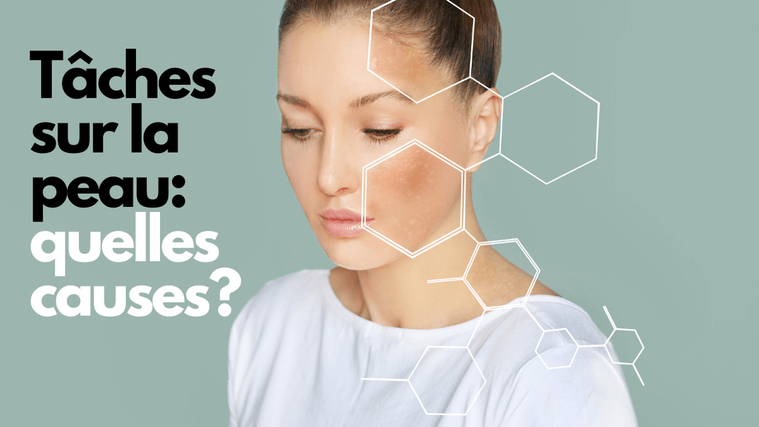 Tâches sur la peau: quelles causes et remèdes?