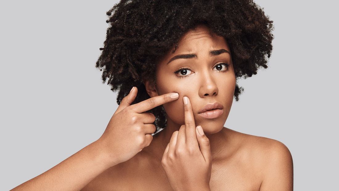 Acné peau noire: les solutions