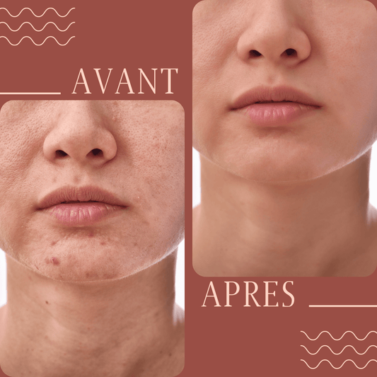 savon lait de chevre acne avant apres