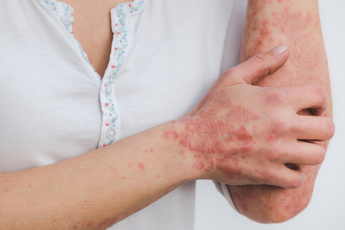 Savon Lait de Chevre Psoriasis