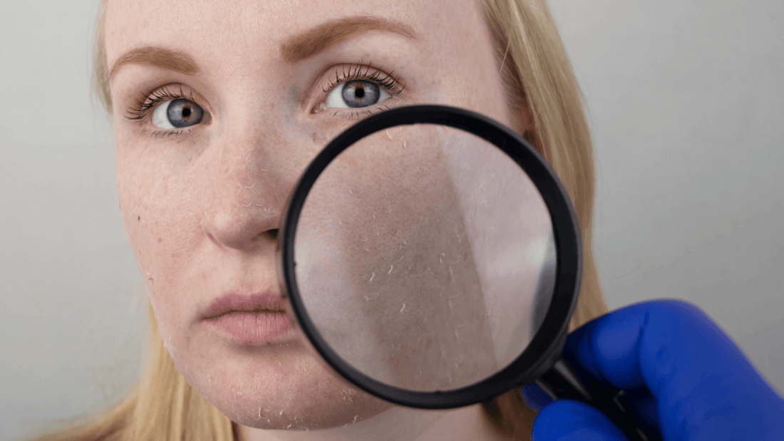 Savon pour eczema et psoriasis