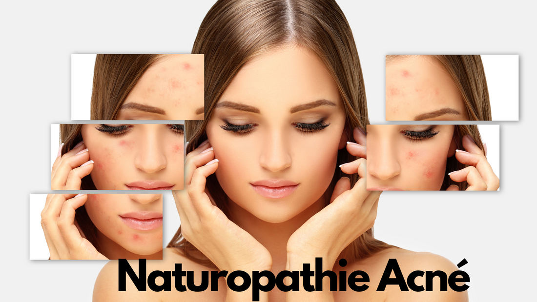 Naturopathie acné