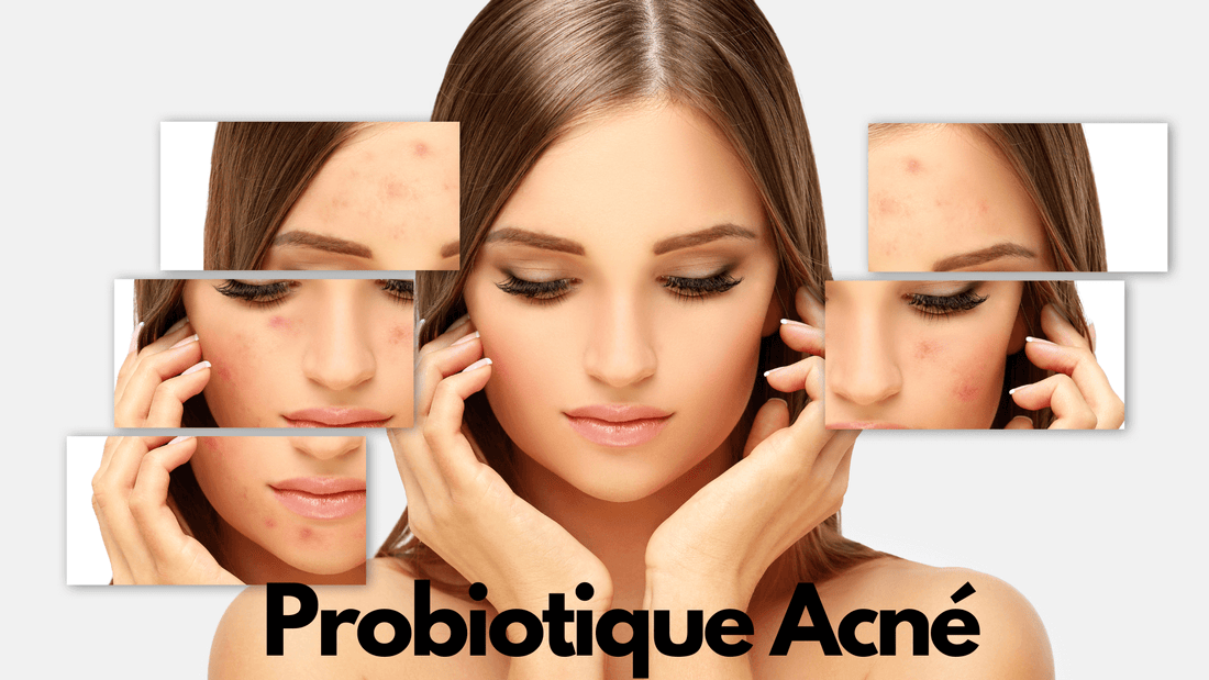 Probiotique acné