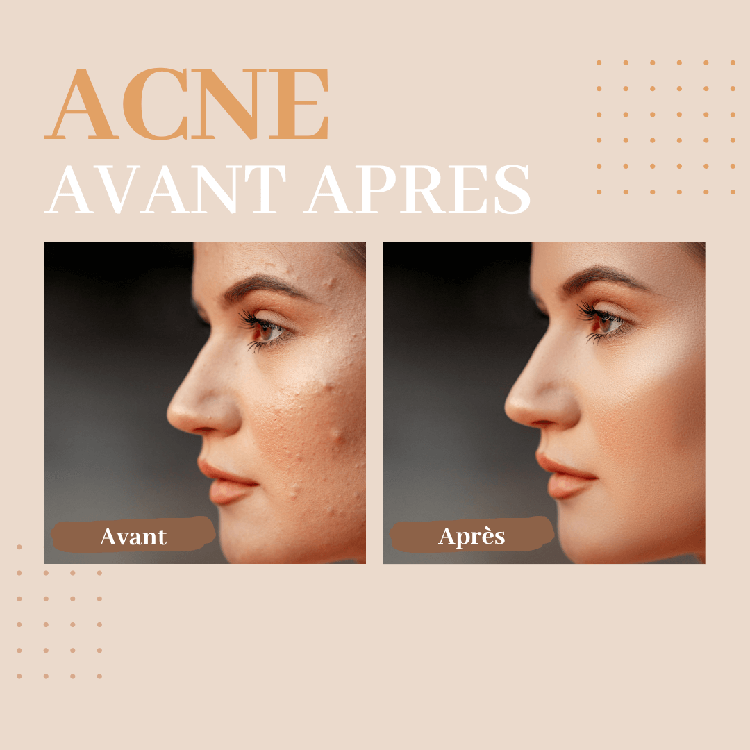 acné avant après