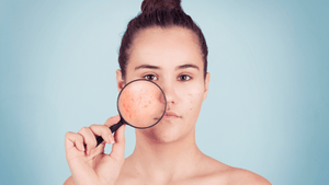Acné digestive: les solutions
