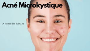 Acné microkystique: quelle solutions?