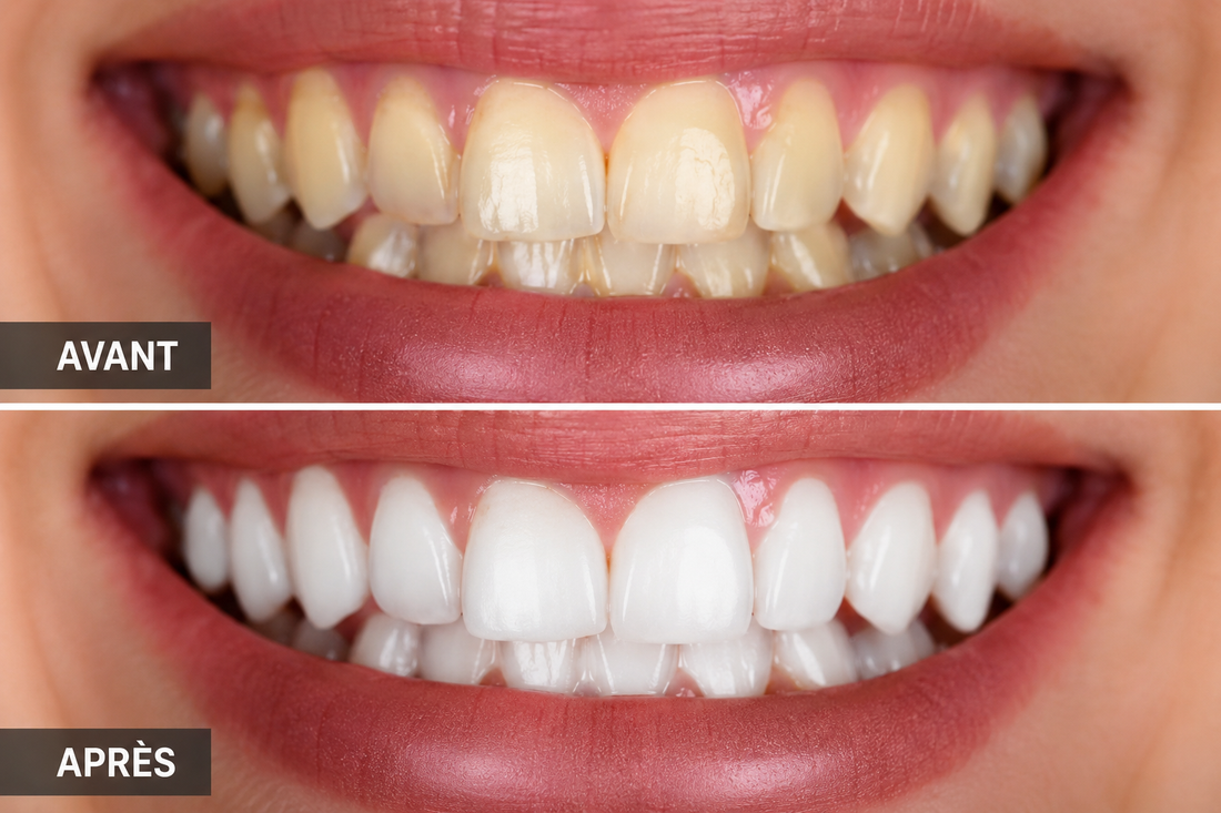 Blanchiment dentaire : tout ce qu’il faut savoir avant de vouloir des dents plus blanches