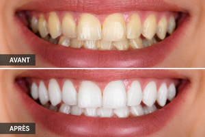 Blanchiment dentaire : tout ce qu’il faut savoir avant de vouloir des dents plus blanches