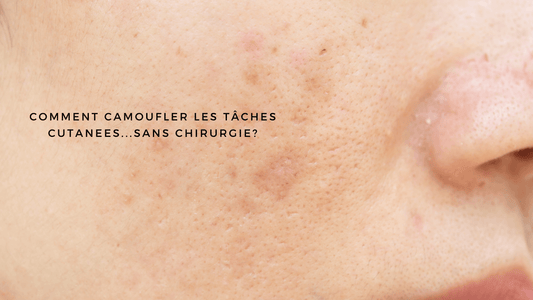 Comment masquer les tâches cutanées...sans chirurgie?