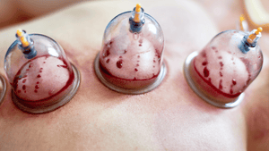 La signification d'une hijama avec sang noir