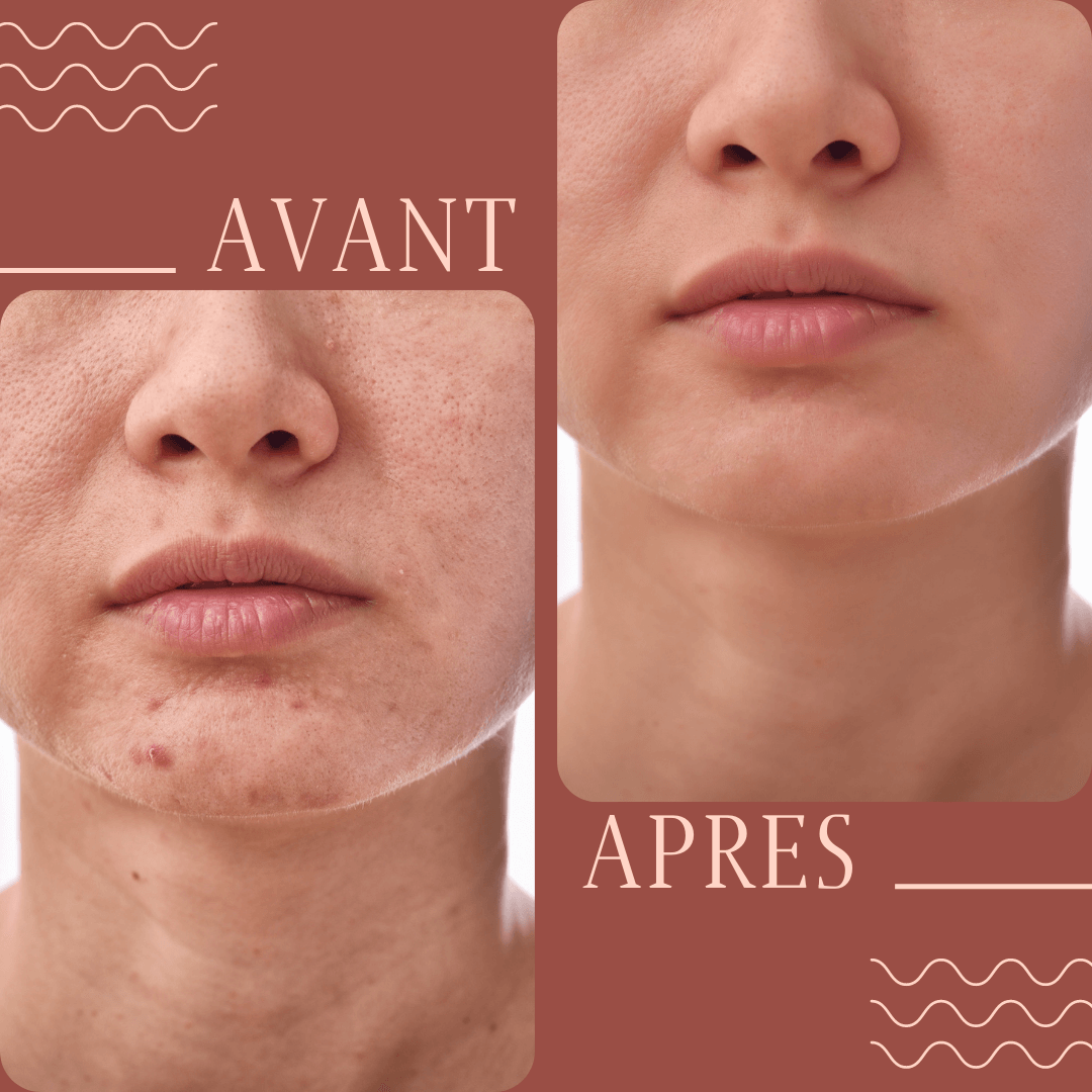savon lait de chevre acne avant apres