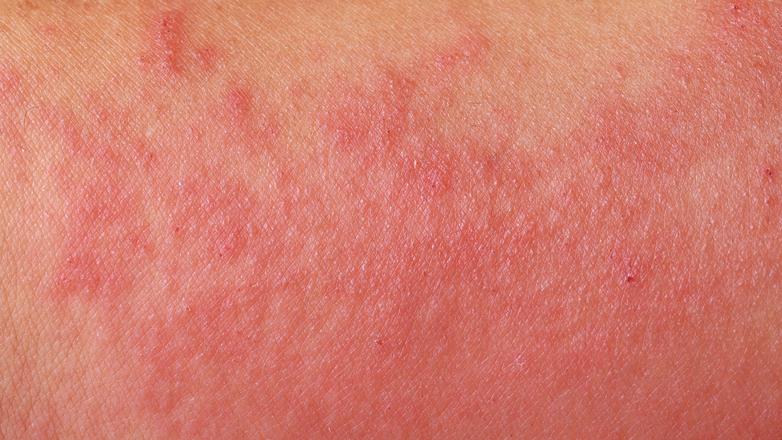 savon lait de chevre eczema