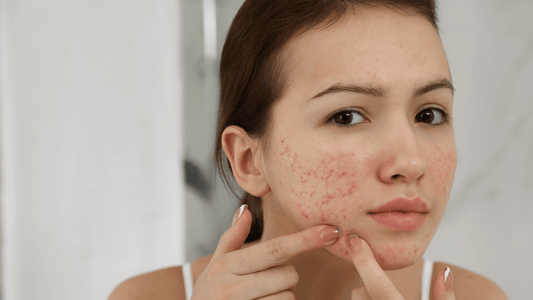 savon lait de chèvre fait ressortir les boutons